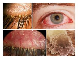symptoms of the presence of parasites under human skin